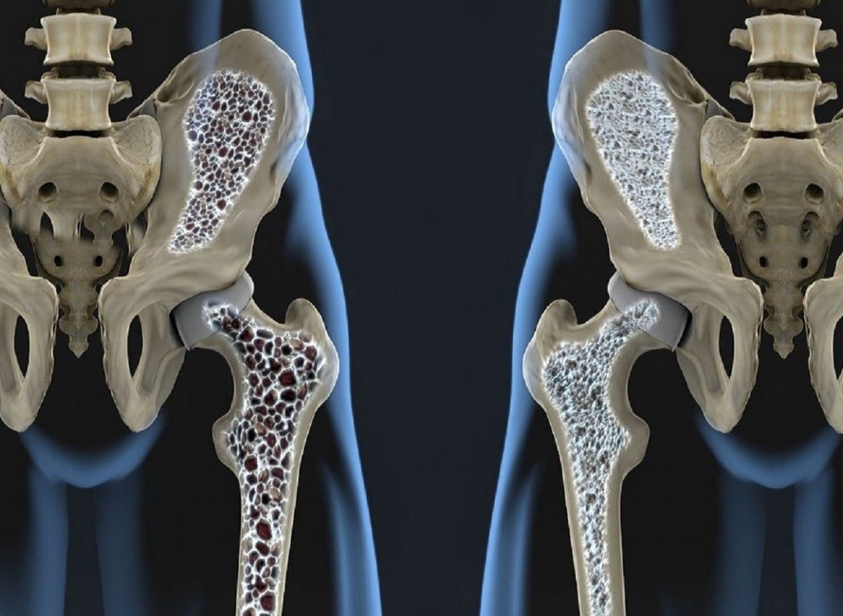 Osteoporosi, come prevenire e curare