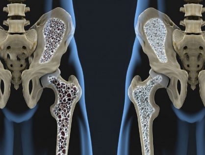 Osteoporosi, come prevenire e curare